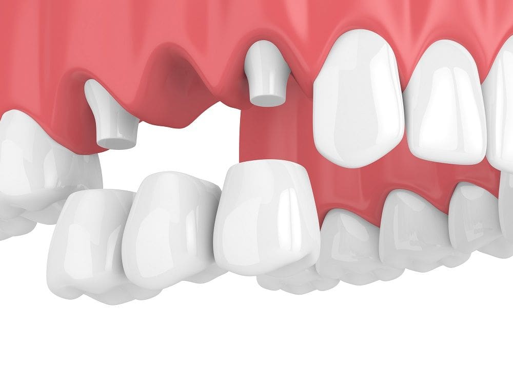 Dental Bridge in Charlotte, NC