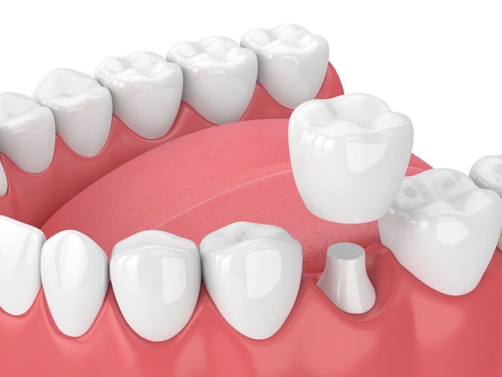 Dental Crown in Charlotte, NC