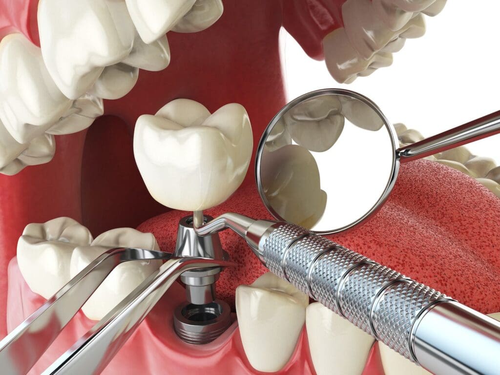 Dental Implants in Charlotte, NC