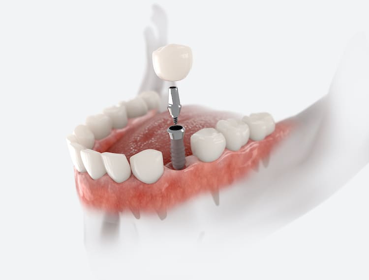 While the dental implant process may seem complex at first glance, breaking it down into manageable stages reveals its logical flow.