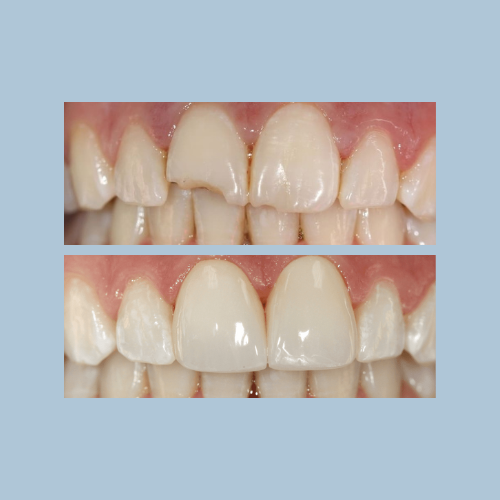 Zoom Whitening & Porcelain Crowns