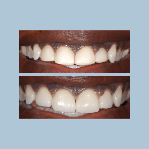 Porcelain Crowns