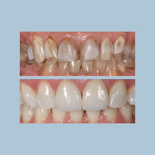 Porcelain Crowns