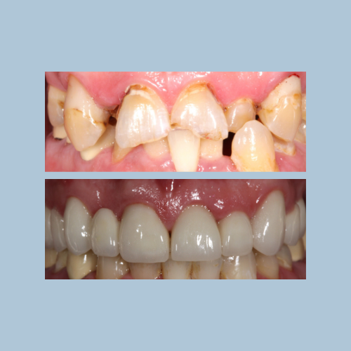 Full Mouth Reconstruction: Orthodontics, Zoom Whitening, Bridge & Crowns