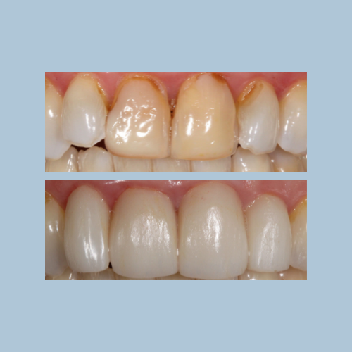 Porcelain Crowns