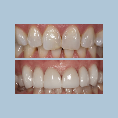 Ceramic Crowns