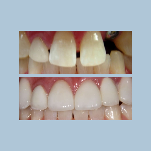 Dental Implants & Ceramic Crowns