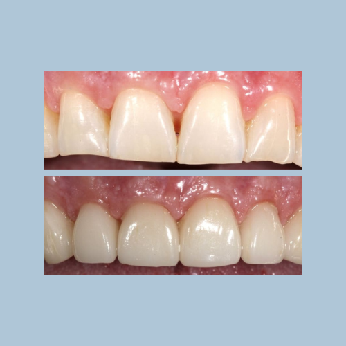 Porcelain Crowns